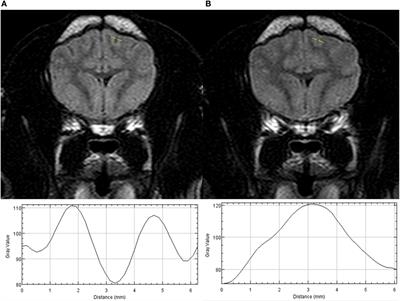 Hyperintensity of Cerebrospinal Fluid on T2-Weighted Fluid-Attenuated Inversion Recovery Magnetic Resonance Imaging Caused by High Inspired Oxygen Fraction